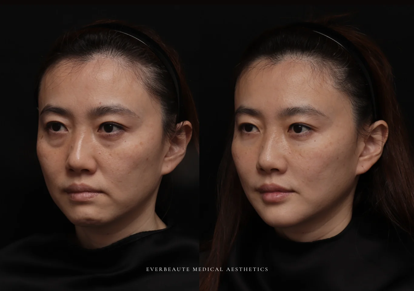 台北醫美推薦 大安區醫美 桃園微整 淚溝 眼袋 黑眼圈 木偶紋 蘋果肌 印地安紋 貓咪紋 嘴邊肉下垂 非手術 無痕拉提 凝境美學診所 曾繁聞醫師 于曉恩醫師 皮膚科 專科 專業 效果自然 微整形 填補 填充 瑞士緹奧希 玻尿酸 喬雅登 水無痕 保柔緹 女神動態 熊貓針 淚溝針 童顏針 伊蓮絲 精靈針 喬雅露 逆時針 價格 副作用 後遺症 dcard ptt 成功案例04