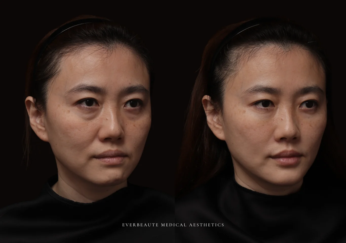 台北醫美推薦 大安區醫美 桃園微整 淚溝 眼袋 黑眼圈 木偶紋 蘋果肌 印地安紋 貓咪紋 嘴邊肉下垂 非手術 無痕拉提 凝境美學診所 曾繁聞醫師 于曉恩醫師 皮膚科 專科 專業 效果自然 微整形 填補 填充 瑞士緹奧希 玻尿酸 喬雅登 水無痕 保柔緹 女神動態 熊貓針 淚溝針 童顏針 伊蓮絲 精靈針 喬雅露 逆時針 價格 副作用 後遺症 dcard ptt 成功案例05