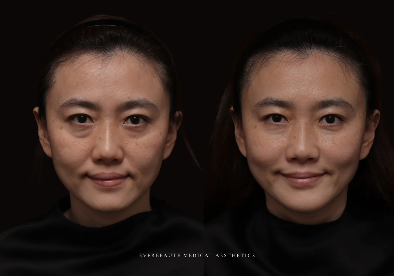 台北醫美推薦 大安區醫美 桃園微整 淚溝 眼袋 黑眼圈 木偶紋 蘋果肌 印地安紋 貓咪紋 嘴邊肉下垂 非手術 無痕拉提 凝境美學診所 曾繁聞醫師 于曉恩醫師 皮膚科 專科 專業 效果自然 微整形 填補 填充 瑞士緹奧希 玻尿酸 喬雅登 水無痕 保柔緹 女神動態 熊貓針 淚溝針 童顏針 伊蓮絲 精靈針 喬雅露 逆時針 價格 副作用 後遺症 dcard ptt 成功案例06