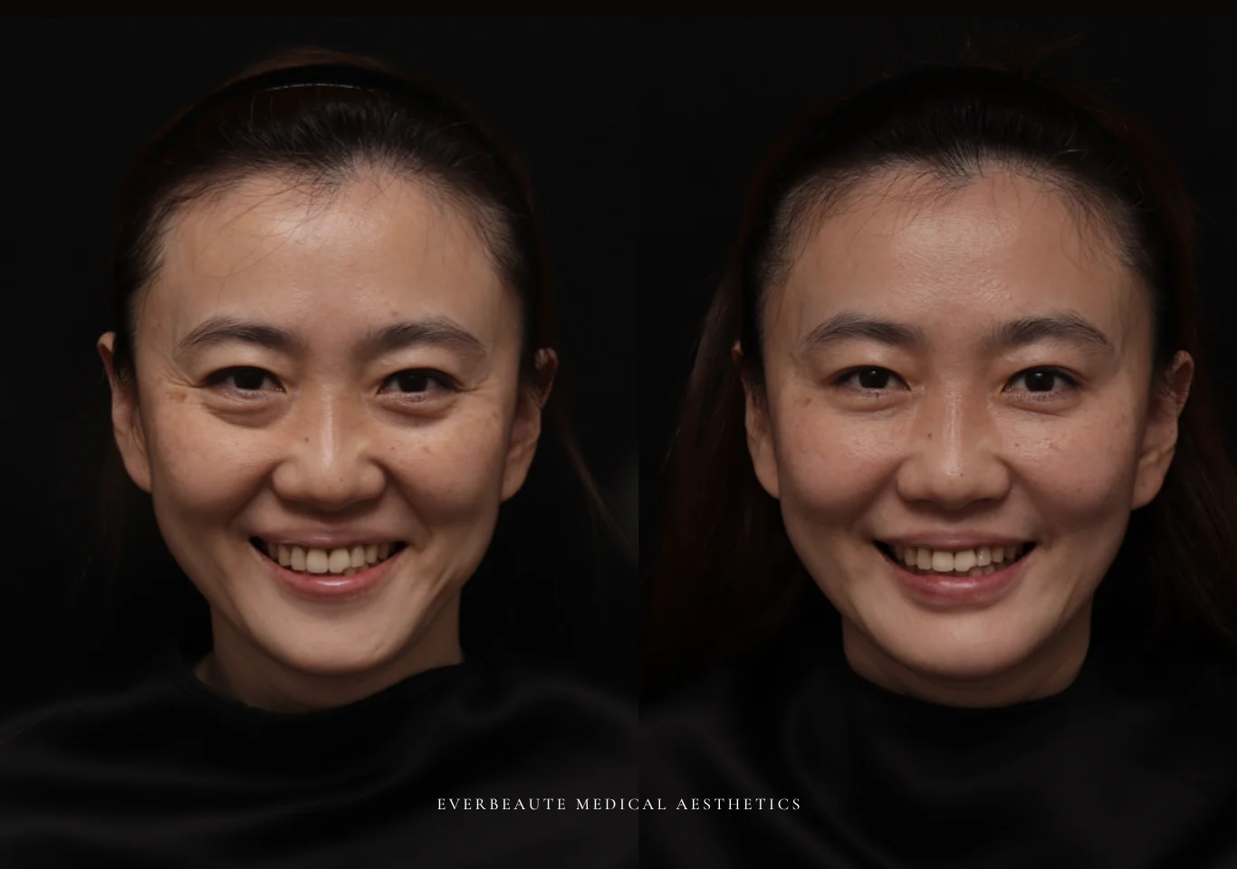 台北醫美推薦 大安區醫美 桃園微整 淚溝 眼袋 黑眼圈 木偶紋 蘋果肌 印地安紋 貓咪紋 嘴邊肉下垂 非手術 無痕拉提 凝境美學診所 曾繁聞醫師 于曉恩醫師 皮膚科 專科 專業 效果自然 微整形 填補 填充 瑞士緹奧希 玻尿酸 喬雅登 水無痕 保柔緹 女神動態 熊貓針 淚溝針 童顏針 伊蓮絲 精靈針 喬雅露 逆時針 價格 副作用 後遺症 dcard ptt 成功案例07