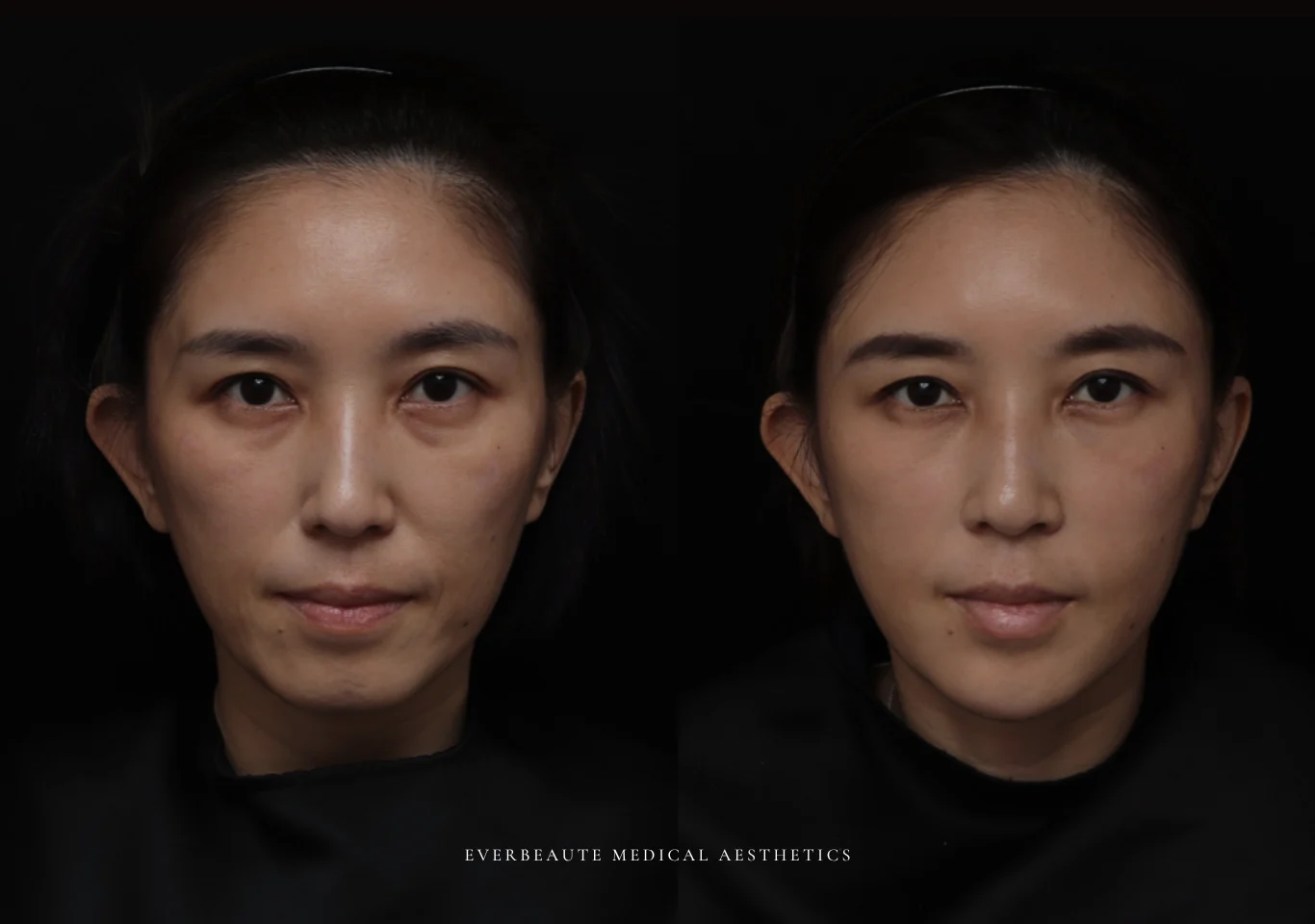 台北醫美推薦 大安區醫美 桃園微整 淚溝 眼袋 黑眼圈 木偶紋 蘋果肌 印地安紋 貓咪紋 嘴邊肉下垂 非手術 無痕拉提 凝境美學診所 曾繁聞醫師 于曉恩醫師 皮膚科 專科 專業 效果自然 微整形 填補 填充 瑞士緹奧希 玻尿酸 喬雅登 水無痕 保柔緹 女神動態 熊貓針 淚溝針 童顏針 伊蓮絲 精靈針 喬雅露 逆時針 價格 副作用 後遺症 dcard ptt 成功案例08