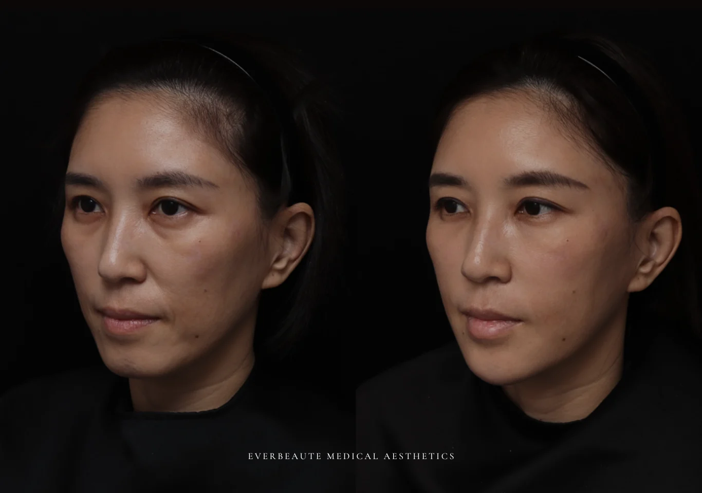 台北醫美推薦 大安區醫美 桃園微整 淚溝 眼袋 黑眼圈 木偶紋 蘋果肌 印地安紋 貓咪紋 嘴邊肉下垂 非手術 無痕拉提 凝境美學診所 曾繁聞醫師 于曉恩醫師 皮膚科 專科 專業 效果自然 微整形 填補 填充 瑞士緹奧希 玻尿酸 喬雅登 水無痕 保柔緹 女神動態 熊貓針 淚溝針 童顏針 伊蓮絲 精靈針 喬雅露 逆時針 價格 副作用 後遺症 dcard ptt 成功案例09