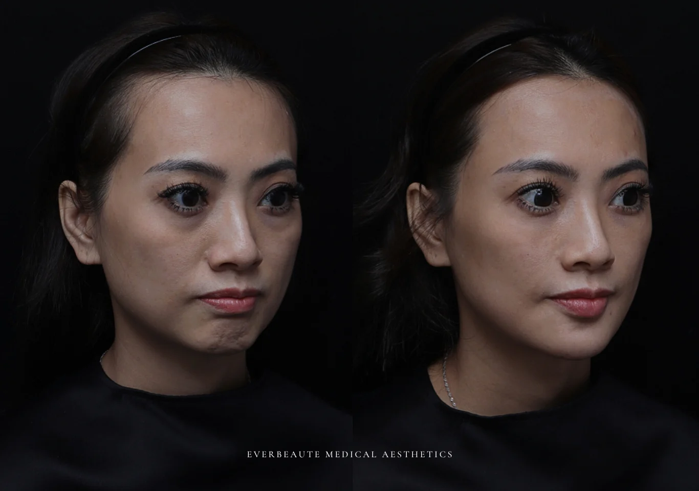 台北醫美推薦 大安區醫美 桃園微整 淚溝 眼袋 黑眼圈 豐唇 木偶紋 凝境美學診所 曾繁聞醫師 于曉恩醫師 皮膚科 專科 專業 效果自然 微整形 填補 填充 瑞士緹奧希 玻尿酸 喬雅登 水無痕 保柔緹 女神動態 熊貓針 淚溝針 童顏針 伊蓮絲 精靈針 喬雅露 逆時針 價格 副作用 後遺症 dcard ptt 成功案例 玻尿酸豐唇前後對比 豐唇、玻尿酸豐唇、自然豐唇、唇形改善、唇線重塑、唇峰設計、唇部微整形、豐唇注射推薦、自然飽滿唇、唇部玻尿酸 1998