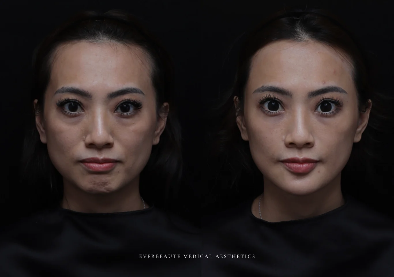 台北醫美推薦 大安區醫美 桃園微整 淚溝 眼袋 黑眼圈 豐唇 木偶紋 凝境美學診所 曾繁聞醫師 于曉恩醫師 皮膚科 專科 專業 效果自然 微整形 填補 填充 瑞士緹奧希 玻尿酸 喬雅登 水無痕 保柔緹 女神動態 熊貓針 淚溝針 童顏針 伊蓮絲 精靈針 喬雅露 逆時針 價格 副作用 後遺症 dcard ptt 成功案例 玻尿酸豐唇前後對比 豐唇、玻尿酸豐唇、自然豐唇、唇形改善、唇線重塑、唇峰設計、唇部微整形、豐唇注射推薦、自然飽滿唇、唇部玻尿酸 1999