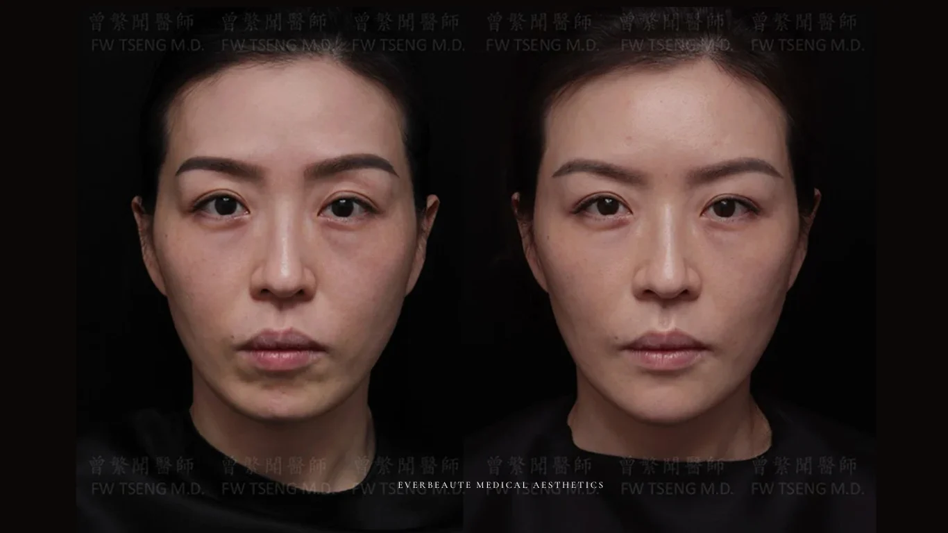 台北醫美推薦 大安區醫美 桃園微整 淚溝 眼袋 黑眼圈 豐唇 木偶紋 凝境美學診所 曾繁聞醫師 于曉恩醫師 皮膚科 專科 專業 效果自然 微整形 填補 填充 瑞士緹奧希 玻尿酸 喬雅登 水無痕 保柔緹 女神動態 熊貓針 淚溝針 童顏針 伊蓮絲 精靈針 喬雅露 逆時針 價格 副作用 後遺症 dcard ptt 成功案例 玻尿酸豐唇前後對比 豐唇、玻尿酸豐唇、自然豐唇、唇形改善、唇線重塑、唇峰設計、唇部微整形、豐唇注射推薦、自然飽滿唇、唇部玻尿酸 18