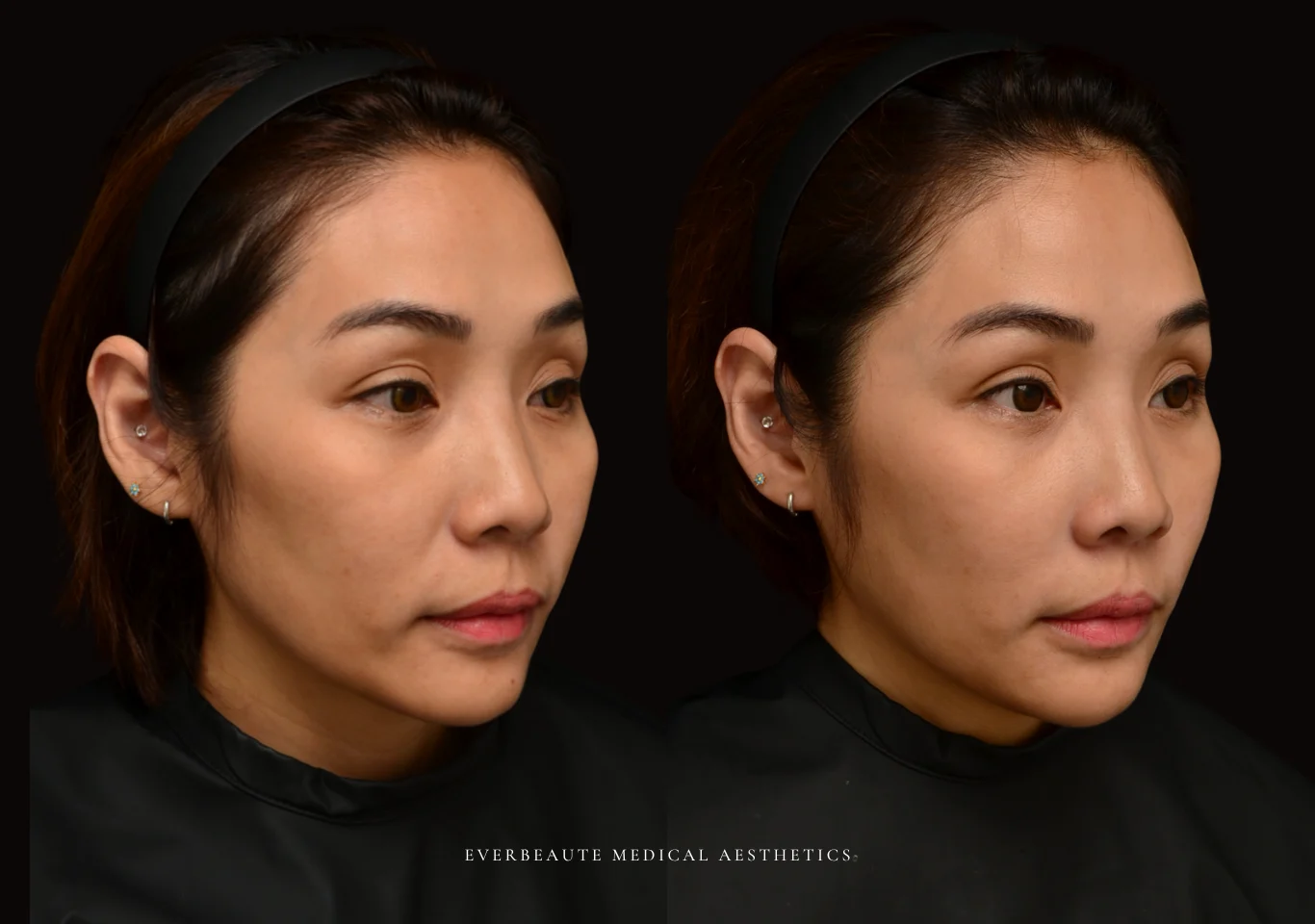 台北醫美推薦 大安區醫美 桃園微整 法令紋 非手術 無痕拉提 凝境美學診所 曾繁聞醫師 于曉恩醫師 皮膚科 專科 專業 效果自然 微整形 填補 填充 瑞士緹奧希 玻尿酸 喬雅登 水無痕 保柔緹 女神動態 熊貓針 淚溝針 童顏針 伊蓮絲 精靈針 喬雅露 逆時針 價格 副作用 後遺症 dcard ptt 成功案例1