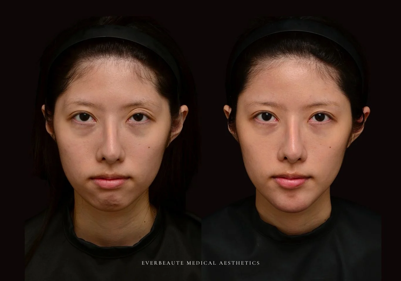 台北醫美推薦 大安區醫美 桃園微整 豐額頭 太陽穴填補 夫妻宮凹陷 上眼窩凹陷 淚溝 眼袋 黑眼圈 鼻基底凹陷 下巴後縮 木偶紋 下顎輪廓線 非手術 不動刀 無痕拉提 凝境美學診所 曾繁聞醫師 于曉恩醫師 皮膚科 專科 專業 好評 院長 原廠講師級 效果自然 微整形 填補 填充 瑞士緹奧希 玻尿酸 喬雅登 水無痕 保柔緹 女神動態 熊貓針 淚溝針 3D 4D聚左旋乳酸 童顏針 舒顏萃 伊蓮絲 Ellanse 艾麗斯 精靈針 喬雅露 薇貝拉 逆時針 熊貓針 膠原蛋白增生 價格 痛 副作用 後遺症 dcard ptt 成功案例