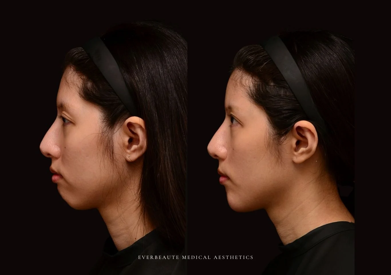 台北醫美推薦 大安區醫美 桃園微整 豐額頭 太陽穴填補 夫妻宮凹陷 上眼窩凹陷 淚溝 眼袋 黑眼圈 鼻基底凹陷 下巴後縮 木偶紋 下顎輪廓線 非手術 不動刀 無痕拉提 凝境美學診所 曾繁聞醫師 于曉恩醫師 皮膚科 專科 專業 好評 院長 原廠講師級 效果自然 微整形 填補 填充 瑞士緹奧希 玻尿酸 喬雅登 水無痕 保柔緹 女神動態 熊貓針 淚溝針 3D 4D聚左旋乳酸 童顏針 舒顏萃 伊蓮絲 Ellanse 艾麗斯 精靈針 喬雅露 薇貝拉 逆時針 熊貓針 膠原蛋白增生 價格 痛 副作用 後遺症 dcard ptt 成功案例3