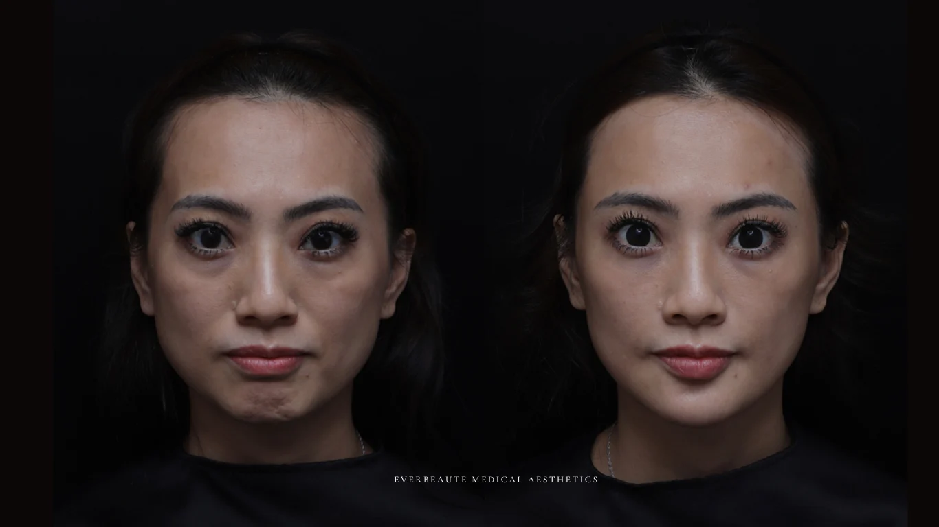 夫妻宮凹陷 太陽穴凹陷｜夫妻宮填補 台北醫美推薦 大安區醫美 桃園微整 淚溝 眼袋 黑眼圈 豐唇 木偶紋 凝境美學診所 曾繁聞醫師 于曉恩醫師 皮膚科 專科 專業 效果自然 微整形 填補 填充 瑞士緹奧希 玻尿酸 喬雅登 水無痕 保柔緹 女神動態 熊貓針 淚溝針 童顏針 伊蓮絲 精靈針 喬雅露 逆時針 價格 副作用 後遺症 dcard ptt 成功案例 玻尿酸豐唇前後對比 豐唇、玻尿酸豐唇、自然豐唇、唇形改善、唇線重塑、唇峰設計、唇部微整形、豐唇注射推薦、自然飽滿唇、唇部玻尿酸 20 凝境美學診所院長醫師擔任精靈針Aesthefill艾麗斯原廠國際級講師 示範注射教學案例 豐唇、太陽穴、臉頰凹陷、淚溝、蘋果肌 6