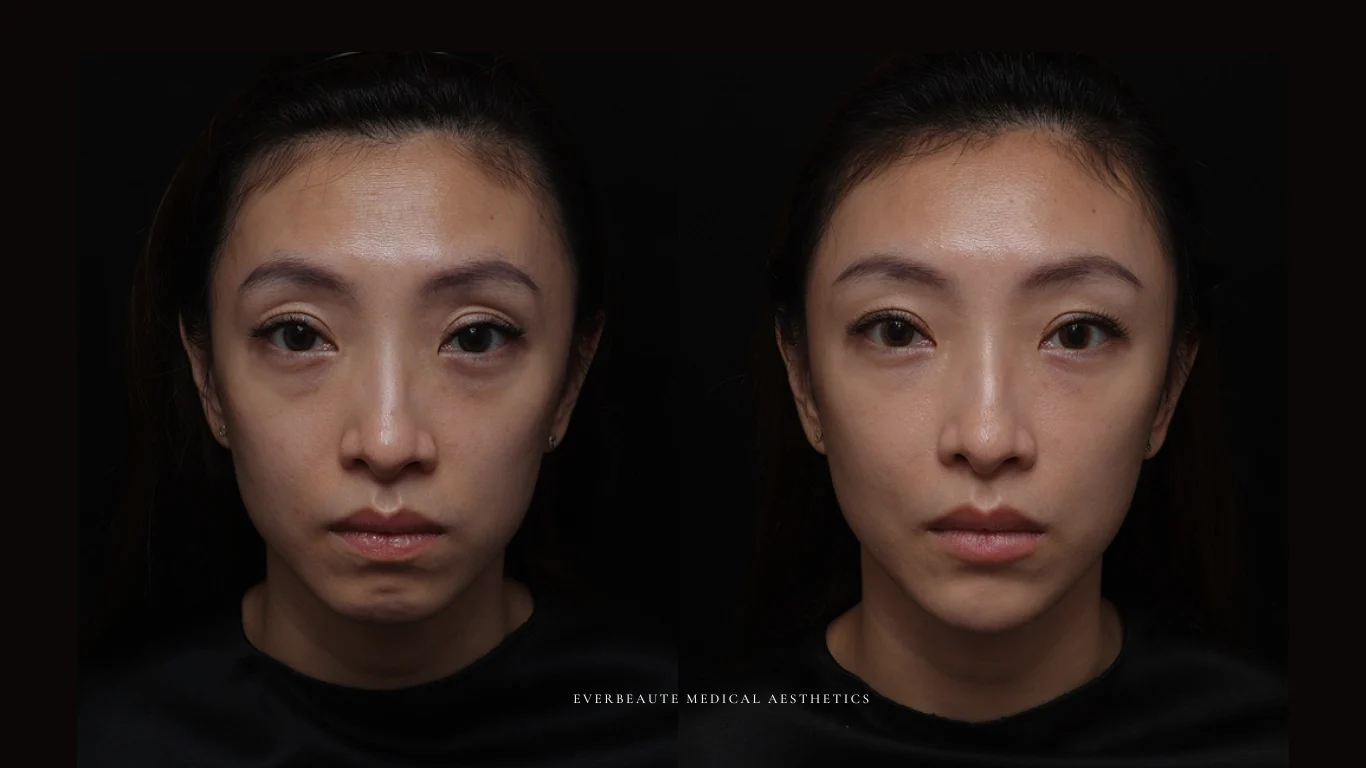 夫妻宮凹陷 太陽穴凹陷｜夫妻宮填補 台北醫美推薦 大安區醫美 桃園微整 淚溝 眼袋 黑眼圈 豐唇 木偶紋 凝境美學診所 曾繁聞醫師 于曉恩醫師 皮膚科 專科 專業 效果自然 微整形 填補 填充 瑞士緹奧希 玻尿酸 喬雅登 水無痕 保柔緹 女神動態 熊貓針 淚溝針 童顏針 伊蓮絲 精靈針 喬雅露 逆時針 價格 副作用 後遺症 dcard ptt 成功案例 玻尿酸豐唇前後對比 豐唇、玻尿酸豐唇、自然豐唇、唇形改善、唇線重塑、唇峰設計、唇部微整形、豐唇注射推薦、自然飽滿唇、唇部玻尿酸 20 凝境美學診所院長醫師擔任精靈針Aesthefill艾麗斯原廠國際級講師 示範注射教學案例 豐唇、太陽穴、臉頰凹陷、淚溝、蘋果肌 7