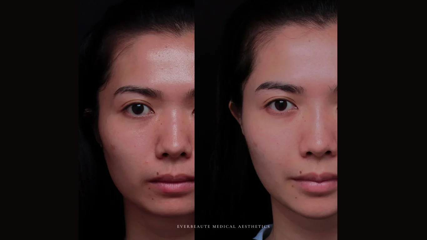 台北醫美推薦 大安區醫美 桃園微整 淚溝 眼袋 黑眼圈 豐唇 木偶紋 凝境美學診所 曾繁聞醫師 于曉恩醫師 皮膚科 專科 專業 效果自然 微整形 填補 填充 瑞士緹奧希 玻尿酸 喬雅登 水無痕 保柔緹 女神動態 熊貓針 淚溝針 童顏針 伊蓮絲 精靈針 喬雅露 逆時針 價格 副作用 後遺症 dcard ptt 成功案例 玻尿酸豐唇前後對比 豐唇、玻尿酸豐唇、自然豐唇、唇形改善、唇線重塑、唇峰設計、唇部微整形、豐唇注射推薦、自然飽滿唇、唇部玻尿酸 22