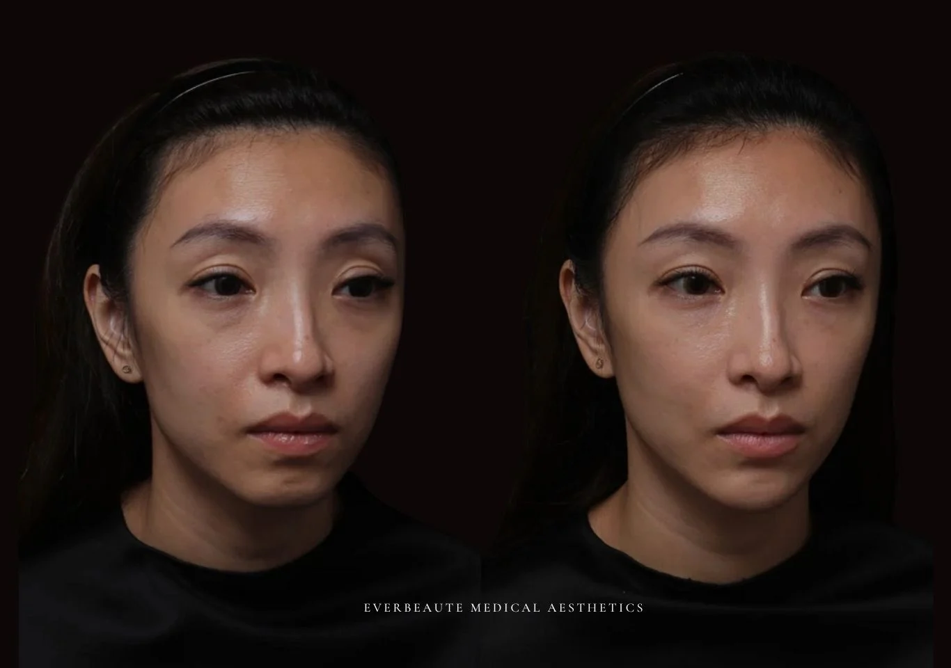 夫妻宮凹陷 太陽穴凹陷｜夫妻宮填補 台北醫美推薦 大安區醫美 桃園微整 淚溝 眼袋 黑眼圈 豐唇 木偶紋 凝境美學診所 曾繁聞醫師 于曉恩醫師 皮膚科 專科 專業 效果自然 微整形 填補 填充 瑞士緹奧希 玻尿酸 喬雅登 水無痕 保柔緹 女神動態 熊貓針 淚溝針 童顏針 伊蓮絲 精靈針 喬雅露 逆時針 價格 副作用 後遺症 dcard ptt 成功案例 玻尿酸豐唇前後對比 豐唇、玻尿酸豐唇、自然豐唇、唇形改善、唇線重塑、唇峰設計、唇部微整形、豐唇注射推薦、自然飽滿唇、唇部玻尿酸 20 凝境美學診所院長醫師擔任精靈針Aesthefill艾麗斯原廠國際級講師 示範注射教學案例 豐唇、太陽穴、臉頰凹陷、淚溝、蘋果肌 台北醫美 1