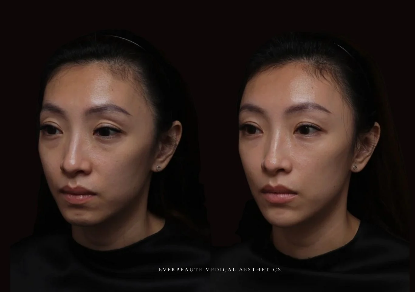 夫妻宮凹陷 太陽穴凹陷｜夫妻宮填補 台北醫美推薦 大安區醫美 桃園微整 淚溝 眼袋 黑眼圈 豐唇 木偶紋 凝境美學診所 曾繁聞醫師 于曉恩醫師 皮膚科 專科 專業 效果自然 微整形 填補 填充 瑞士緹奧希 玻尿酸 喬雅登 水無痕 保柔緹 女神動態 熊貓針 淚溝針 童顏針 伊蓮絲 精靈針 喬雅露 逆時針 價格 副作用 後遺症 dcard ptt 成功案例 玻尿酸豐唇前後對比 豐唇、玻尿酸豐唇、自然豐唇、唇形改善、唇線重塑、唇峰設計、唇部微整形、豐唇注射推薦、自然飽滿唇、唇部玻尿酸 20 凝境美學診所院長醫師擔任精靈針Aesthefill艾麗斯原廠國際級講師 示範注射教學案例 豐唇、太陽穴、臉頰凹陷、淚溝、蘋果肌 台北醫美 2