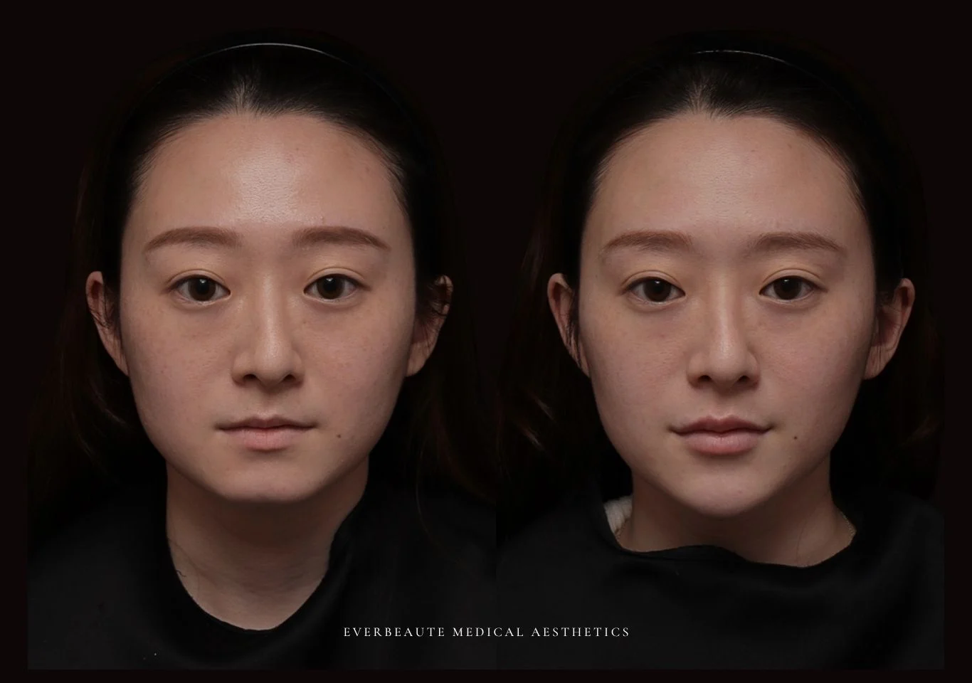 改善雙下巴 下顎線 大安醫美 凝境美學診所 于曉恩 曾繁聞 雙下巴 臉頰肉 輪廓線 肉毒小臉 拉提緊緻 鳳凰電波 索夫波 美國音波二代