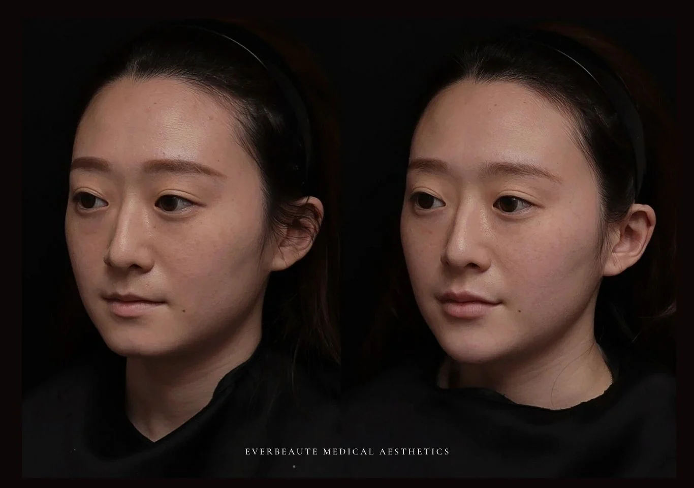 改善雙下巴 下顎線 大安醫美 凝境美學診所 于曉恩 曾繁聞 雙下巴 臉頰肉 輪廓線 肉毒小臉 拉提緊緻 鳳凰電波 索夫波 美國音波二代 電波音波差異