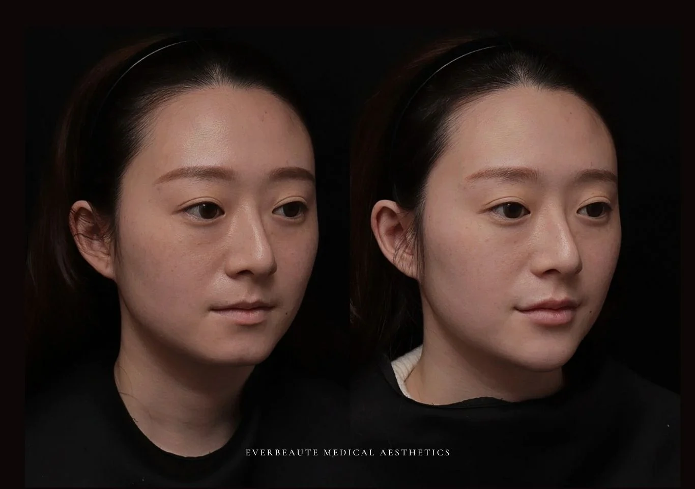 改善雙下巴 下顎線 大安醫美 凝境美學診所 于曉恩 曾繁聞 雙下巴 臉頰肉 輪廓線 肉毒小臉 拉提緊緻 鳳凰電波 索夫波 美國音波二代 電波音波差異 Ulthera