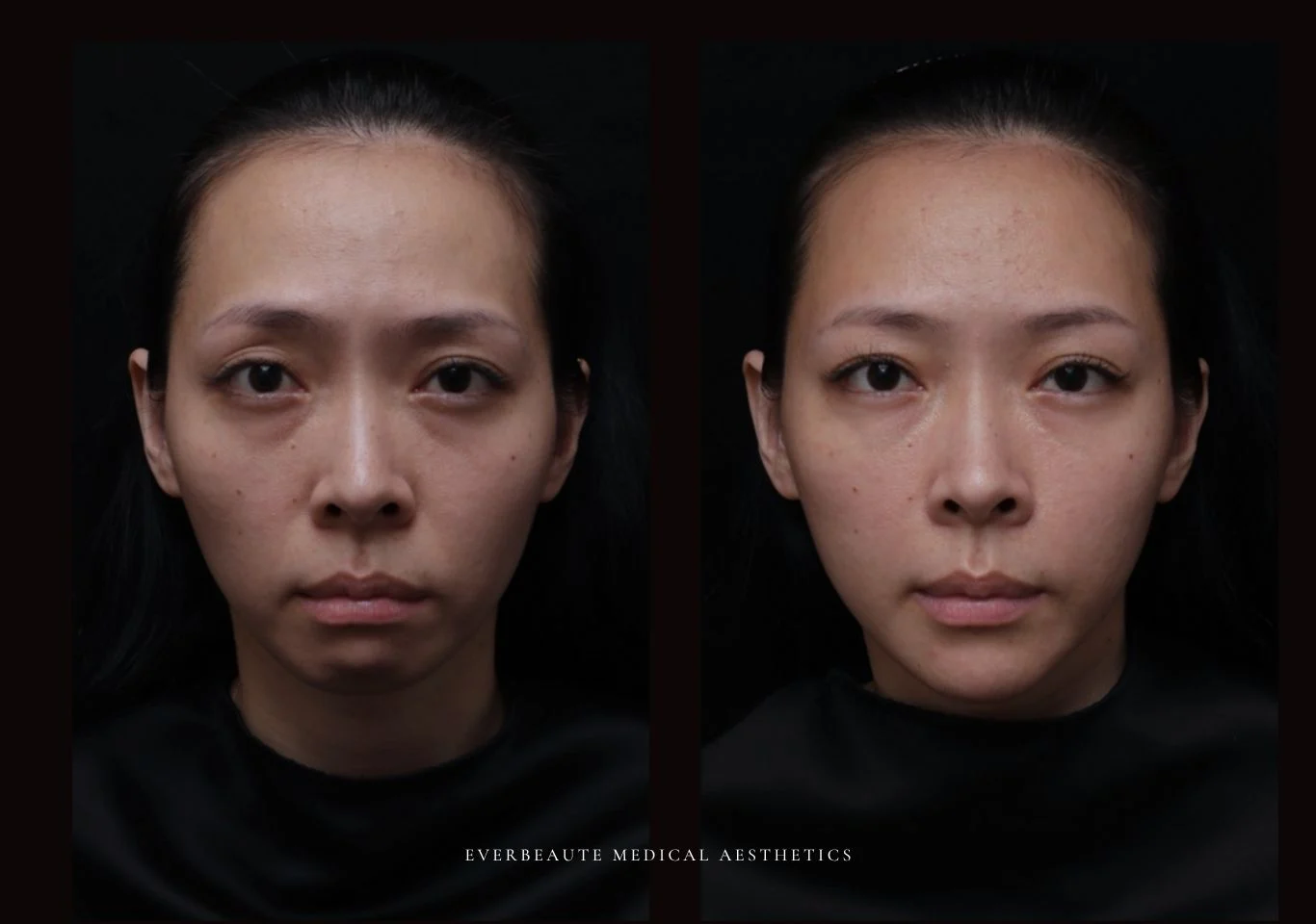 台北醫美推薦 大安區醫美 桃園微整 淚溝 眼袋 黑眼圈 木偶紋 蘋果肌 印地安紋 貓咪紋 嘴邊肉下垂 非手術 無痕拉提 凝境美學診所 曾繁聞醫師 于曉恩醫師 皮膚科 專科 專業 效果自然 微整形 填補 填充 瑞士緹奧希 玻尿酸 喬雅登 水無痕 保柔緹 女神動態 熊貓針 淚溝針 童顏針 伊蓮絲 精靈針 喬雅露 逆時針 價格 副作用 後遺症 dcard ptt 成功案例 雙下巴 下顎線 0001