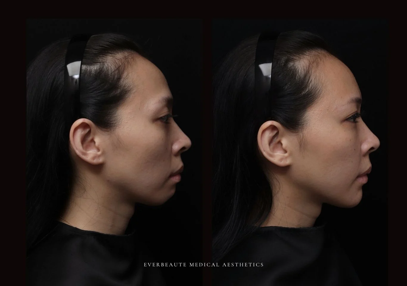 台北醫美推薦 大安區醫美 桃園微整 淚溝 眼袋 黑眼圈 木偶紋 蘋果肌 印地安紋 貓咪紋 嘴邊肉下垂 非手術 無痕拉提 凝境美學診所 曾繁聞醫師 于曉恩醫師 皮膚科 專科 專業 效果自然 微整形 填補 填充 瑞士緹奧希 玻尿酸 喬雅登 水無痕 保柔緹 女神動態 熊貓針 淚溝針 童顏針 伊蓮絲 精靈針 喬雅露 逆時針 價格 副作用 後遺症 dcard ptt 成功案例 雙下巴 下顎線 0004