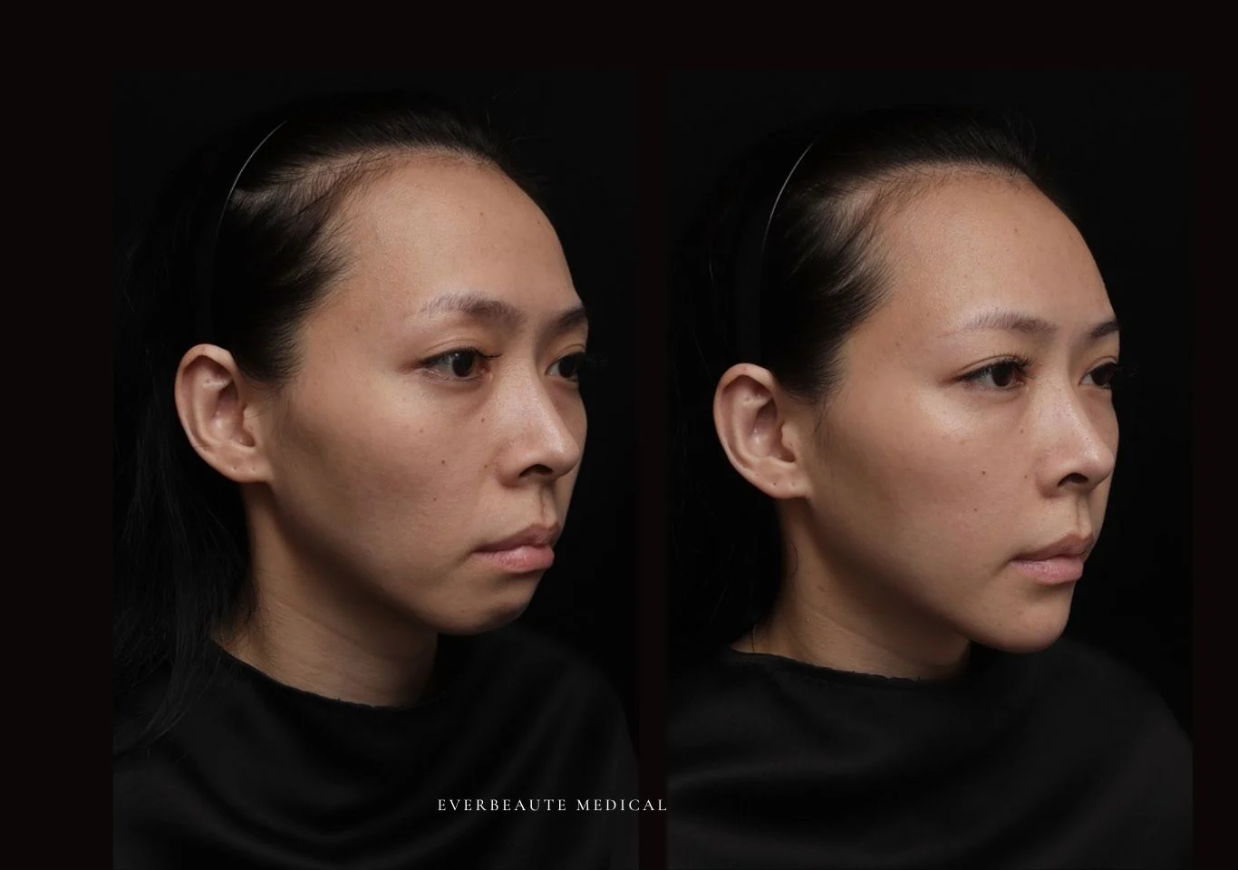 台北醫美推薦 大安區醫美 桃園微整 淚溝 眼袋 黑眼圈 木偶紋 蘋果肌 印地安紋 貓咪紋 嘴邊肉下垂 非手術 無痕拉提 凝境美學診所 曾繁聞醫師 于曉恩醫師 皮膚科 專科 專業 效果自然 微整形 填補 填充 瑞士緹奧希 玻尿酸 喬雅登 水無痕 保柔緹 女神動態 熊貓針 淚溝針 童顏針 伊蓮絲 精靈針 喬雅露 逆時針 價格 副作用 後遺症 dcard ptt 成功案例 雙下巴 下顎線 0003