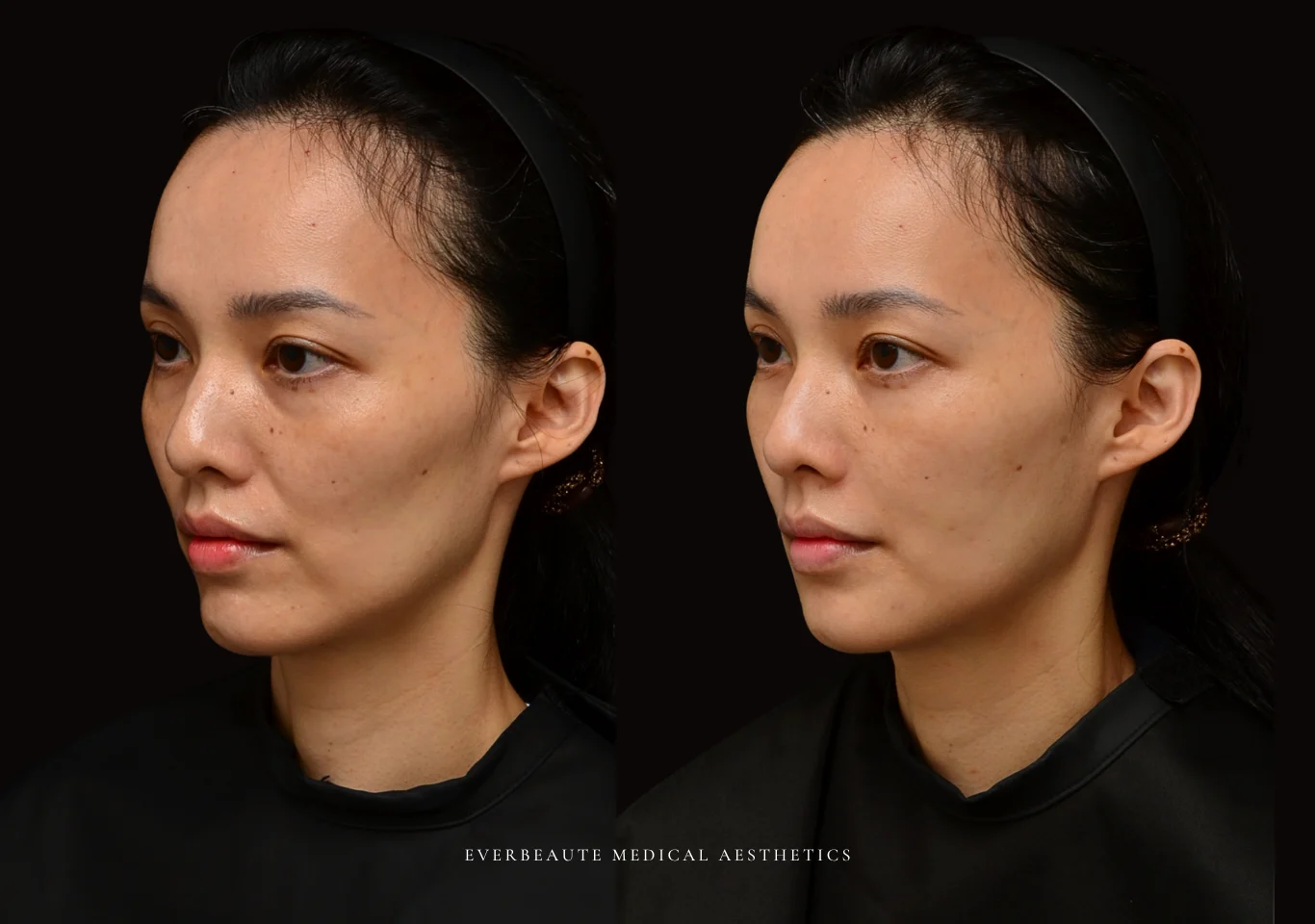 台北醫美推薦 大安區醫美 桃園微整 淚溝 眼袋 黑眼圈 木偶紋 法令紋 非手術 無痕拉提 凝境美學診所 曾繁聞醫師 于曉恩醫師 皮膚科 專科 專業 效果自然 微整形 填補 填充 瑞士緹奧希 玻尿酸 喬雅登 水無痕 保柔緹 女神動態 熊貓針 淚溝針 童顏針 伊蓮絲 精靈針 喬雅露 逆時針 價格 副作用 後遺症 dcard ptt 成功案例0001