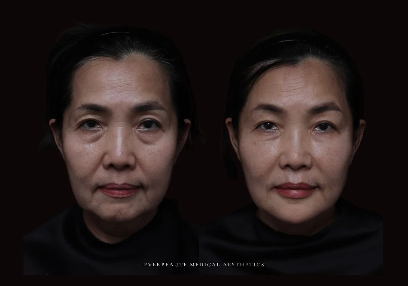 台北醫美推薦 大安區醫美 桃園微整 淚溝 眼袋 黑眼圈 木偶紋 蘋果肌 印地安紋 貓咪紋 嘴邊肉下垂 非手術 無痕拉提 凝境美學診所 曾繁聞醫師 于曉恩醫師 皮膚科 專科 專業 效果自然 微整形 填補 填充 瑞士緹奧希 玻尿酸 喬雅登 水無痕 保柔緹 女神動態 熊貓針 淚溝針 童顏針 伊蓮絲 精靈針 喬雅露 逆時針 價格 副作用 後遺症 dcard ptt 成功案例 0255 細紋皺紋