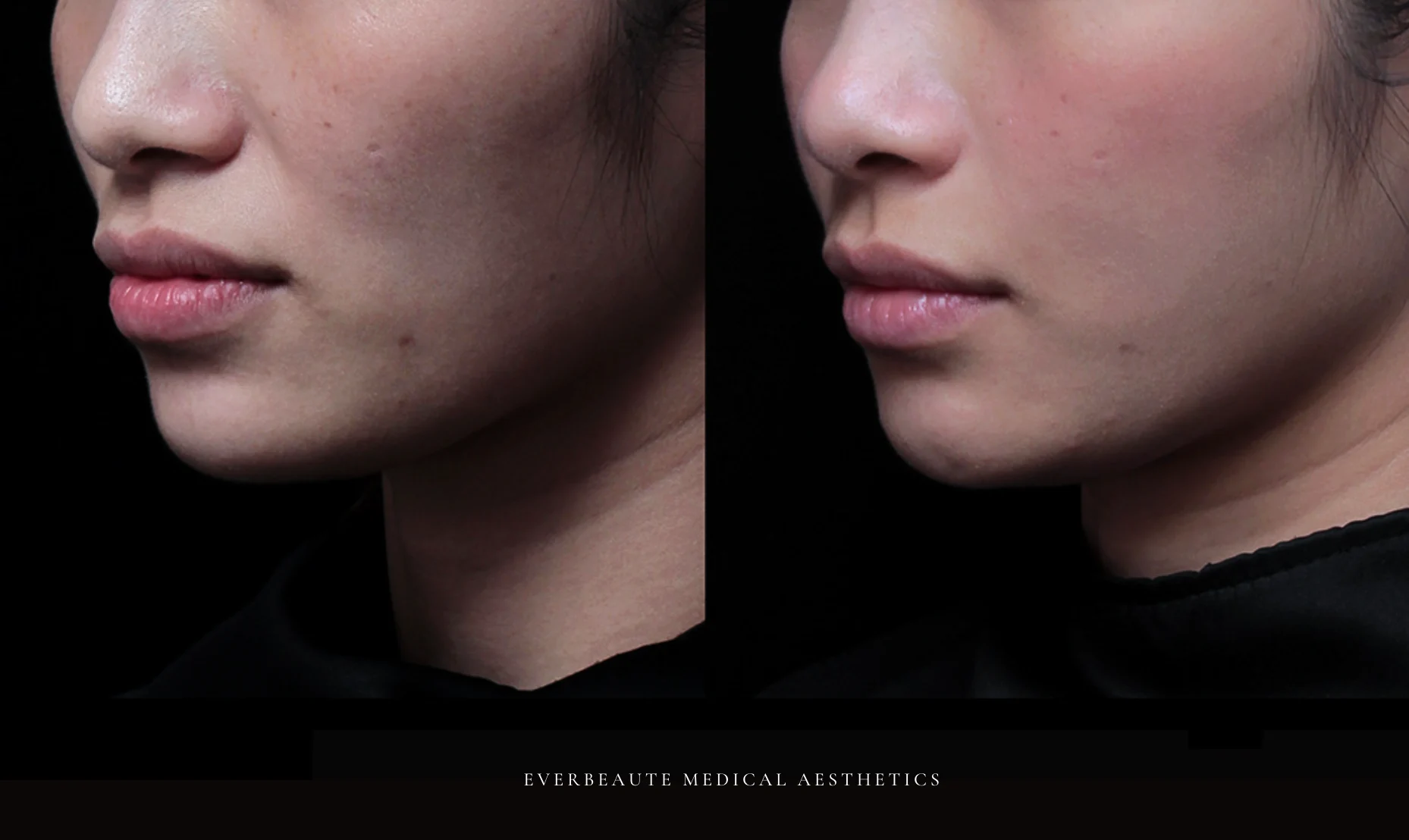 台北醫美推薦 大安區醫美 桃園微整 淚溝 眼袋 黑眼圈 木偶紋 蘋果肌 印地安紋 貓咪紋 嘴邊肉下垂 非手術 無痕拉提 凝境美學診所 曾繁聞醫師 于曉恩醫師 皮膚科 專科 專業 效果自然 微整形 填補 填充 瑞士緹奧希 玻尿酸 喬雅登 水無痕 保柔緹 女神動態 熊貓針 淚溝針 童顏針 伊蓮絲 精靈針 喬雅露 逆時針 價格 副作用 後遺症 dcard ptt 成功案例 015555