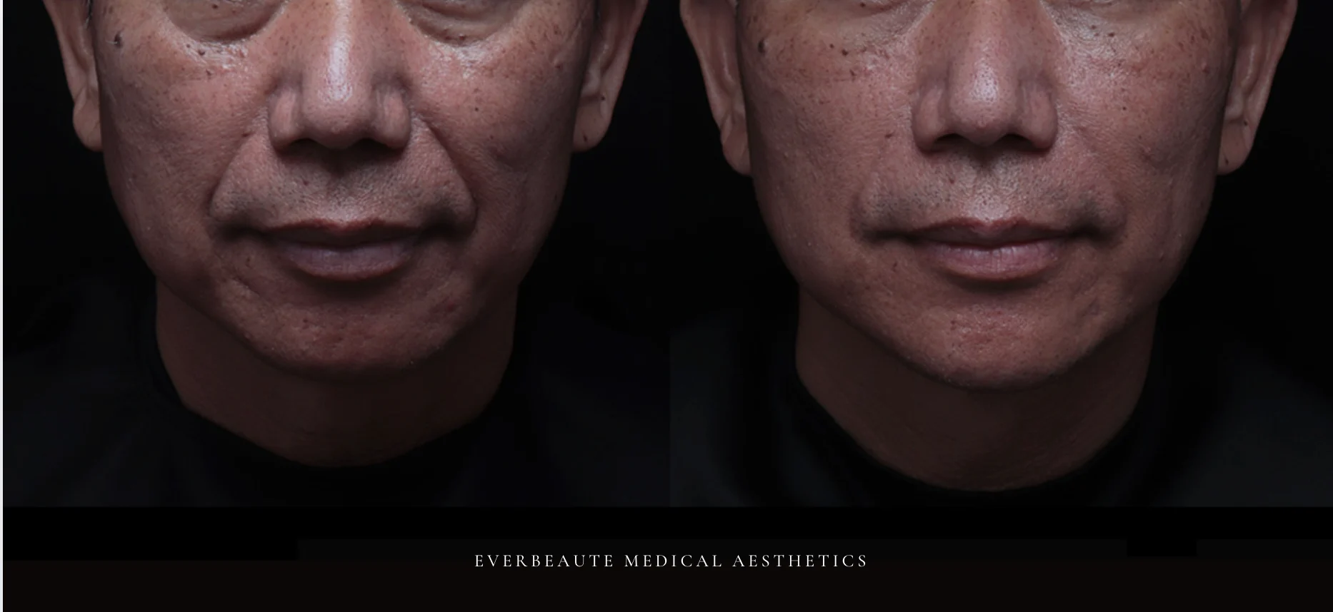 台北醫美推薦 大安區醫美 桃園微整 淚溝 眼袋 黑眼圈 木偶紋 蘋果肌 印地安紋 貓咪紋 嘴邊肉下垂 非手術 無痕拉提 凝境美學診所 曾繁聞醫師 于曉恩醫師 皮膚科 專科 專業 效果自然 微整形 填補 填充 瑞士緹奧希 玻尿酸 喬雅登 水無痕 保柔緹 女神動態 熊貓針 淚溝針 童顏針 伊蓮絲 精靈針 喬雅露 逆時針 價格 副作用 後遺症 dcard ptt 成功案例 015558