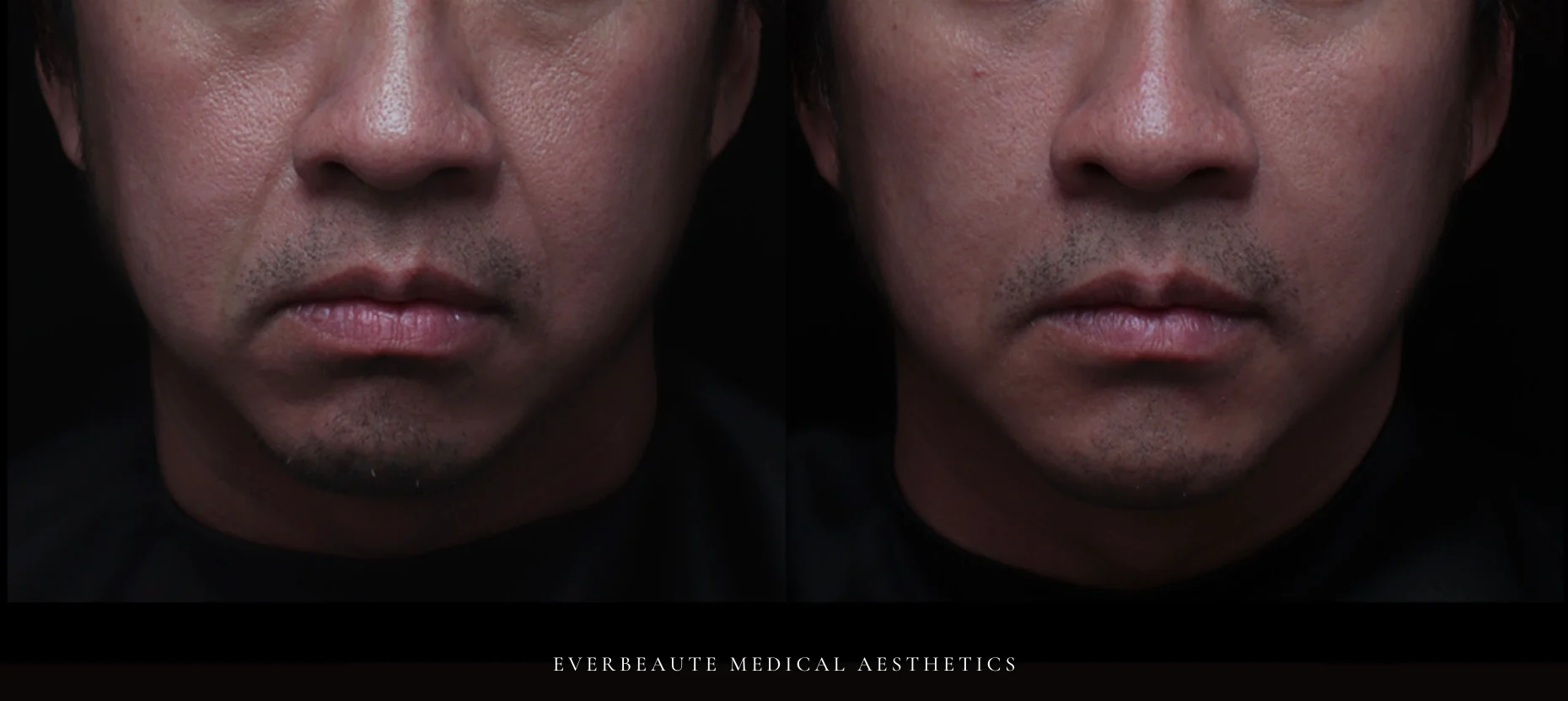 台北醫美推薦 大安區醫美 桃園微整 淚溝 眼袋 黑眼圈 木偶紋 蘋果肌 印地安紋 貓咪紋 嘴邊肉下垂 非手術 無痕拉提 凝境美學診所 曾繁聞醫師 于曉恩醫師 皮膚科 專科 專業 效果自然 微整形 填補 填充 瑞士緹奧希 玻尿酸 喬雅登 水無痕 保柔緹 女神動態 熊貓針 淚溝針 童顏針 伊蓮絲 精靈針 喬雅露 逆時針 價格 副作用 後遺症 dcard ptt 成功案例 0155588