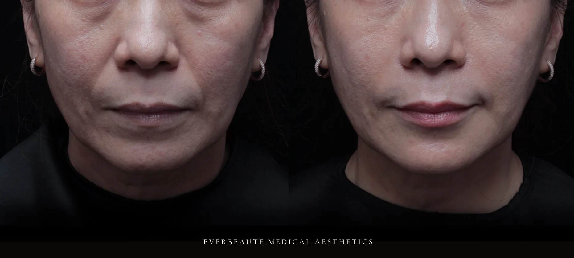 台北醫美推薦 大安區醫美 桃園微整 淚溝 眼袋 黑眼圈 木偶紋 蘋果肌 印地安紋 貓咪紋 嘴邊肉下垂 非手術 無痕拉提 凝境美學診所 曾繁聞醫師 于曉恩醫師 皮膚科 專科 專業 效果自然 微整形 填補 填充 瑞士緹奧希 玻尿酸 喬雅登 水無痕 保柔緹 女神動態 熊貓針 淚溝針 童顏針 伊蓮絲 精靈針 喬雅露 逆時針 價格 副作用 後遺症 dcard ptt 成功案例 0155583