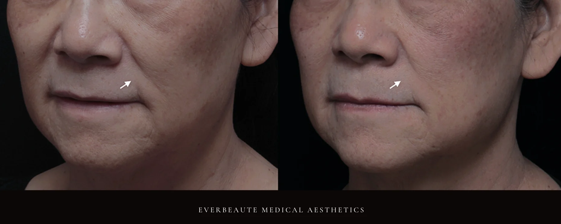 台北醫美推薦 蘋果肌大安區醫美 桃園微整 淚溝 眼袋 黑眼圈 木偶紋 蘋果肌 印地安紋 貓咪紋 嘴邊肉下垂 非手術 無痕拉提 凝境美學診所 曾繁聞醫師 于曉恩醫師 皮膚科 專科 專業 效果自然 微整形 填補 填充 瑞士緹奧希 玻尿酸 喬雅登 水無痕 保柔緹 女神動態 熊貓針 淚溝針 童顏針 伊蓮絲 精靈針 喬雅露 逆時針 價格 副作用 後遺症 dcard ptt 成功案例 0155588