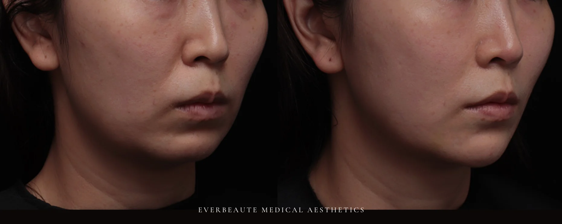 台北醫美推薦 蘋果肌大安區醫美 桃園微整 淚溝 眼袋 黑眼圈 木偶紋 蘋果肌 印地安紋 貓咪紋 嘴邊肉下垂 非手術 無痕拉提 凝境美學診所 曾繁聞醫師 于曉恩醫師 皮膚科 專科 專業 效果自然 微整形 填補 填充 瑞士緹奧希 玻尿酸 喬雅登 水無痕 保柔緹 女神動態 熊貓針 淚溝針 童顏針 伊蓮絲 精靈針 喬雅露 逆時針 價格 副作用 後遺症 dcard ptt 成功案例 0155589