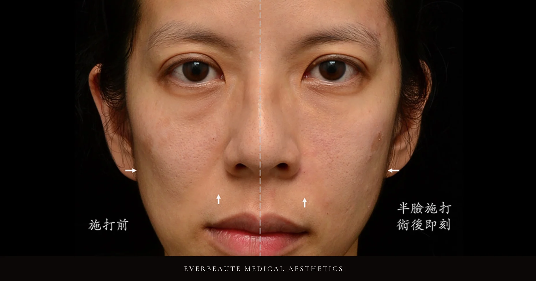 台北醫美推薦 蘋果肌大安區醫美 桃園微整 淚溝 眼袋 黑眼圈 木偶紋 蘋果肌 印地安紋 貓咪紋 嘴邊肉下垂 非手術 無痕拉提 凝境美學診所 曾繁聞醫師 于曉恩醫師 皮膚科 專科 專業 效果自然 微整形 填補 填充 瑞士緹奧希 玻尿酸 喬雅登 水無痕 保柔緹 女神動態 熊貓針 淚溝針 童顏針 伊蓮絲 精靈針 喬雅露 逆時針 價格 副作用 後遺症 dcard ptt 成功案例 01555890