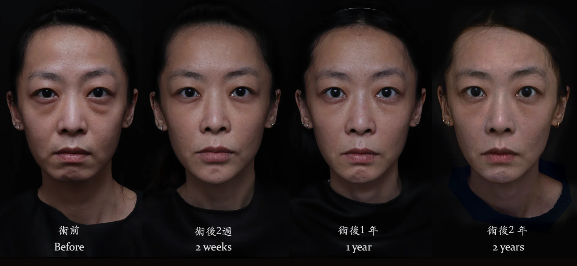 台北醫美推薦 蘋果肌大安區醫美 桃園微整 淚溝 眼袋 黑眼圈 木偶紋 蘋果肌 印地安紋 貓咪紋 嘴邊肉下垂 非手術 無痕拉提 凝境美學診所 曾繁聞醫師 于曉恩醫師 皮膚科 專科 專業 效果自然 微整形 填補 填充 瑞士緹奧希 玻尿酸 喬雅登 水無痕 保柔緹 女神動態 熊貓針 淚溝針 童顏針 伊蓮絲 精靈針 喬雅露 逆時針 價格 副作用 後遺症 dcard ptt 成功案例 下垂 老化 抗老醫美0001