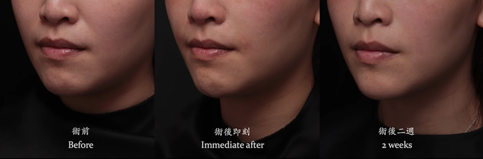 台北醫美推薦 蘋果肌大安區醫美 桃園微整 淚溝 眼袋 黑眼圈 木偶紋 蘋果肌 印地安紋 貓咪紋 嘴邊肉下垂 非手術 無痕拉提 凝境美學診所 曾繁聞醫師 于曉恩醫師 皮膚科 專科 專業 效果自然 微整形 填補 填充 瑞士緹奧希 玻尿酸 喬雅登 水無痕 保柔緹 女神動態 熊貓針 淚溝針 童顏針 伊蓮絲 精靈針 喬雅露 逆時針 價格 副作用 後遺症 dcard ptt 成功案例 下垂 老化 抗老醫美0004