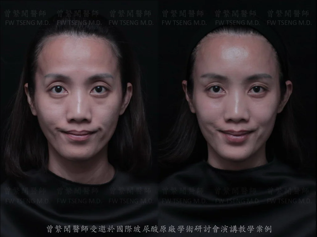 曾繁聞醫師 微整案例 玻尿酸 凝境美學004a