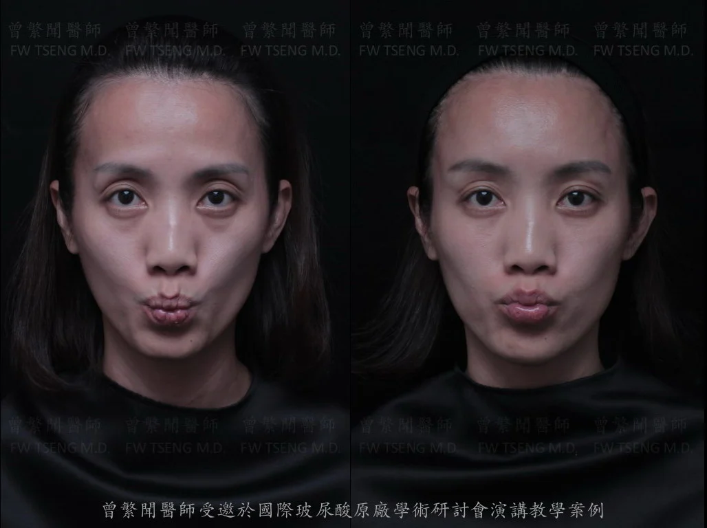 曾繁聞醫師 微整案例 玻尿酸 凝境美學004b