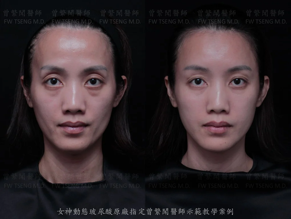 曾繁聞醫師 微整案例 玻尿酸 凝境美學診所 001