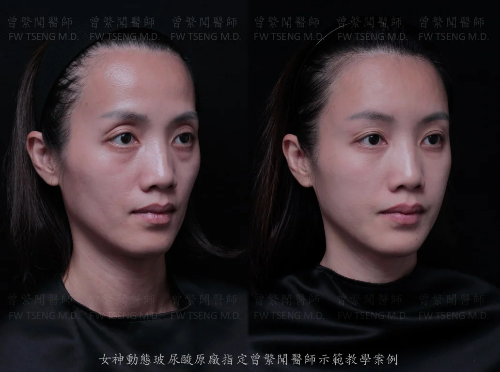 曾繁聞醫師 微整案例 玻尿酸 台北醫美 凝境美學004