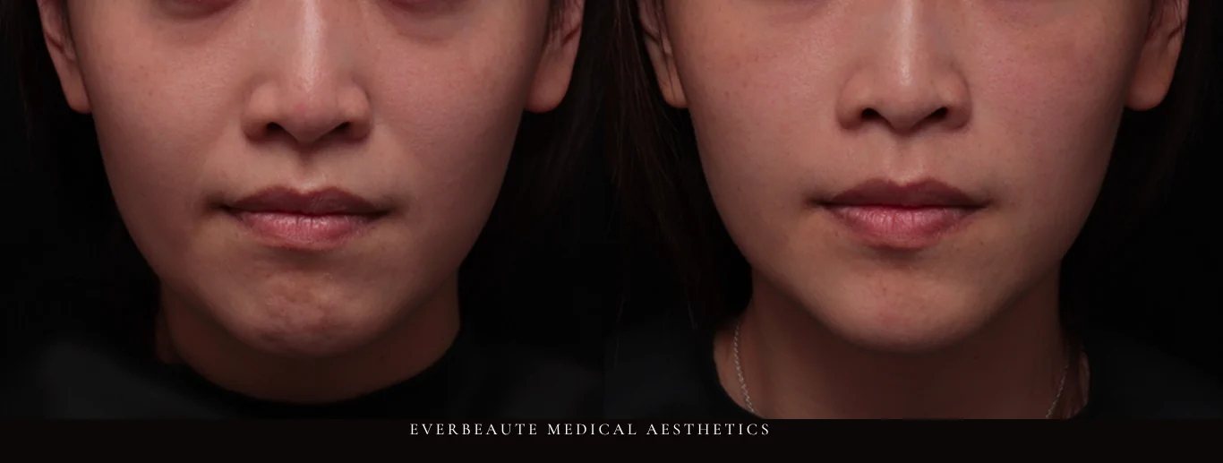 台北醫美推薦 蘋果肌大安區醫美 桃園微整 淚溝 眼袋 黑眼圈 木偶紋 蘋果肌 印地安紋 貓咪紋 嘴邊肉下垂 非手術 無痕拉提 凝境美學診所 曾繁聞醫師 于曉恩醫師 皮膚科 專科 專業 效果自然 微整形 填補 填充 瑞士緹奧希 玻尿酸 喬雅登 水無痕 保柔緹 女神動態 熊貓針 淚溝針 童顏針 伊蓮絲 精靈針 喬雅露 逆時針 價格 副作用 後遺症 dcard ptt 成功案例 下垂 老化 抗老醫美 台北醫美 曾繁聞 于曉恩