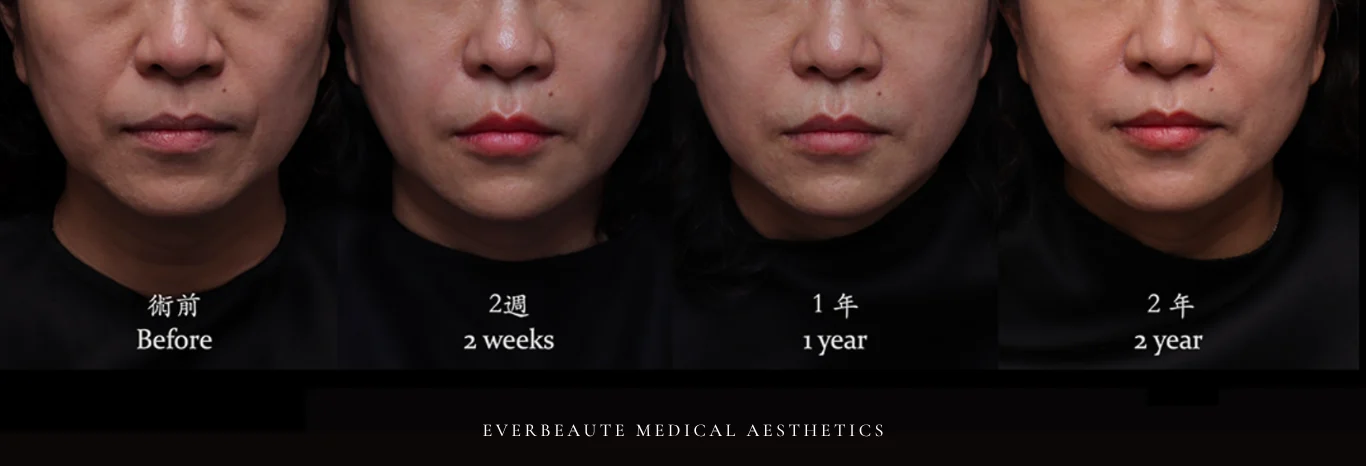 台北醫美推薦 蘋果肌大安區醫美 桃園微整 淚溝 眼袋 黑眼圈 木偶紋 蘋果肌 印地安紋 貓咪紋 嘴邊肉下垂 非手術 無痕拉提 凝境美學診所 曾繁聞醫師 于曉恩醫師 皮膚科 專科 專業 效果自然 微整形 填補 填充 瑞士緹奧希 玻尿酸 喬雅登 水無痕 保柔緹 女神動態 熊貓針 淚溝針 童顏針 伊蓮絲 精靈針 喬雅露 逆時針 價格 副作用 後遺症 dcard ptt 成功案例 下垂 老化 抗老醫美 台北醫美 曾繁聞 于曉恩01