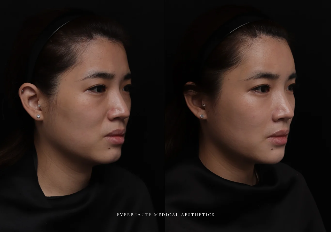 美容醫學世界高峰會日本京都年會 曾繁聞醫師演講教學案例 凝境美學診所 大安區醫美 于曉恩 曾繁聞