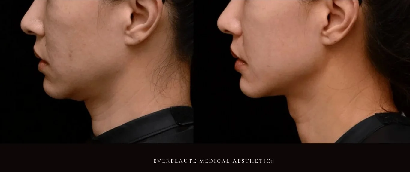 台北醫美推薦 大安區醫美 桃園微整 淚溝 眼袋 黑眼圈 木偶紋 蘋果肌 印地安紋 貓咪紋 嘴邊肉下垂 非手術 無痕拉提 凝境美學診所 曾繁聞醫師 于曉恩醫師 皮膚科 專科 專業 效果自然 微整形 填補 填充 瑞士緹奧希 玻尿酸 喬雅登 水無痕 保柔緹 女神動態 熊貓針 淚溝針 童顏針 伊蓮絲 精靈針 喬雅露 逆時針 價格 副作用 後遺症 dcard ptt 成功案例 0255 細紋皺紋 09