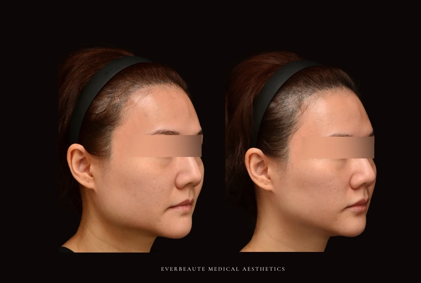 肉毒小臉-瘦臉-咬肌-咀嚼肌 凝境美學診所 于曉恩醫師 曾繁聞醫師 大安區醫美 台北醫美