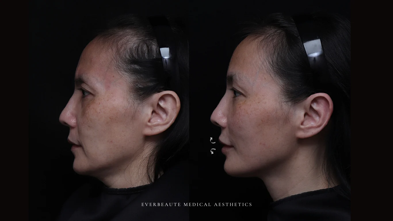 台北醫美推薦 大安區醫美 桃園微整 淚溝 眼袋 黑眼圈 豐唇 木偶紋 凝境美學診所 曾繁聞醫師 于曉恩醫師 皮膚科 專科 專業 效果自然 微整形 填補 填充 瑞士緹奧希 玻尿酸 喬雅登 水無痕 保柔緹 女神動態 熊貓針 淚溝針 童顏針 伊蓮絲 精靈針 喬雅露 逆時針 價格 副作用 後遺症 dcard ptt 成功案例 玻尿酸豐唇前後對比 豐唇、玻尿酸豐唇、自然豐唇、唇形改善、唇線重塑、唇峰設計、唇部微整形、豐唇注射推薦、自然飽滿唇、唇部玻尿酸 9