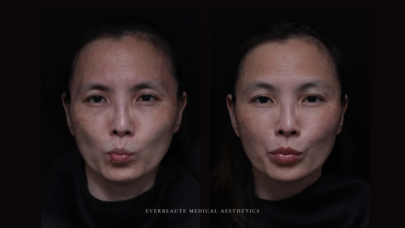 台北醫美推薦 大安區醫美 桃園微整 淚溝 眼袋 黑眼圈 豐唇 木偶紋 凝境美學診所 曾繁聞醫師 于曉恩醫師 皮膚科 專科 專業 效果自然 微整形 填補 填充 瑞士緹奧希 玻尿酸 喬雅登 水無痕 保柔緹 女神動態 熊貓針 淚溝針 童顏針 伊蓮絲 精靈針 喬雅露 逆時針 價格 副作用 後遺症 dcard ptt 成功案例 玻尿酸豐唇前後對比 豐唇、玻尿酸豐唇、自然豐唇、唇形改善、唇線重塑、唇峰設計、唇部微整形、豐唇注射推薦、自然飽滿唇、唇部玻尿酸 10