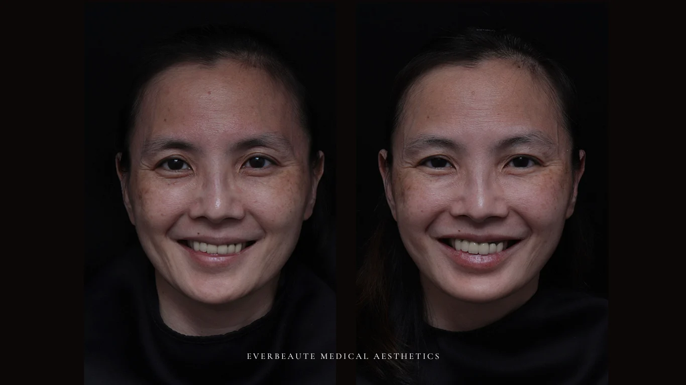 台北醫美推薦 大安區醫美 桃園微整 淚溝 眼袋 黑眼圈 豐唇 木偶紋 凝境美學診所 曾繁聞醫師 于曉恩醫師 皮膚科 專科 專業 效果自然 微整形 填補 填充 瑞士緹奧希 玻尿酸 喬雅登 水無痕 保柔緹 女神動態 熊貓針 淚溝針 童顏針 伊蓮絲 精靈針 喬雅露 逆時針 價格 副作用 後遺症 dcard ptt 成功案例 玻尿酸豐唇前後對比 豐唇、玻尿酸豐唇、自然豐唇、唇形改善、唇線重塑、唇峰設計、唇部微整形、豐唇注射推薦、自然飽滿唇、唇部玻尿酸 11