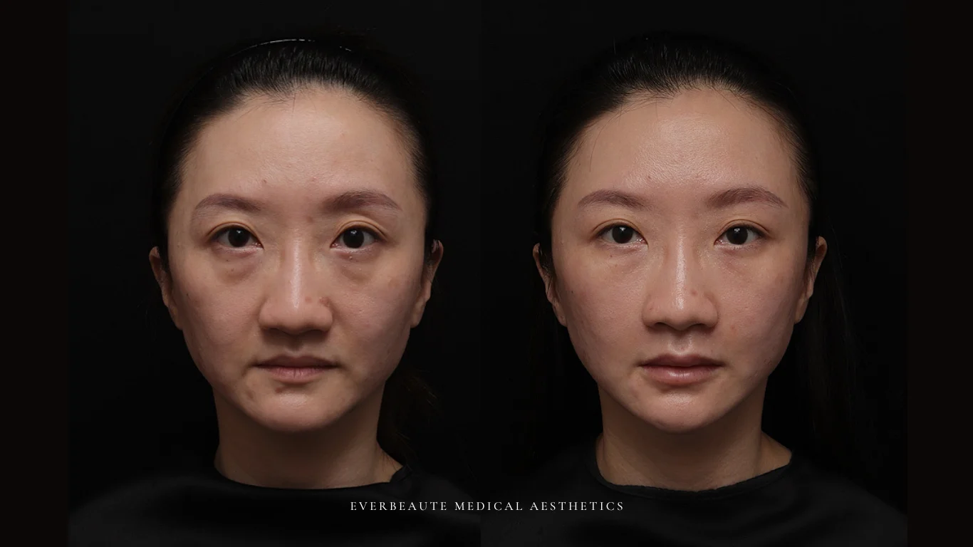 台北醫美推薦 大安區醫美 桃園微整 淚溝 眼袋 黑眼圈 豐唇 木偶紋 凝境美學診所 曾繁聞醫師 于曉恩醫師 皮膚科 專科 專業 效果自然 微整形 填補 填充 瑞士緹奧希 玻尿酸 喬雅登 水無痕 保柔緹 女神動態 熊貓針 淚溝針 童顏針 伊蓮絲 精靈針 喬雅露 逆時針 價格 副作用 後遺症 dcard ptt 成功案例 玻尿酸豐唇前後對比 豐唇、玻尿酸豐唇、自然豐唇、唇形改善、唇線重塑、唇峰設計、唇部微整形、豐唇注射推薦、自然飽滿唇、唇部玻尿酸 12