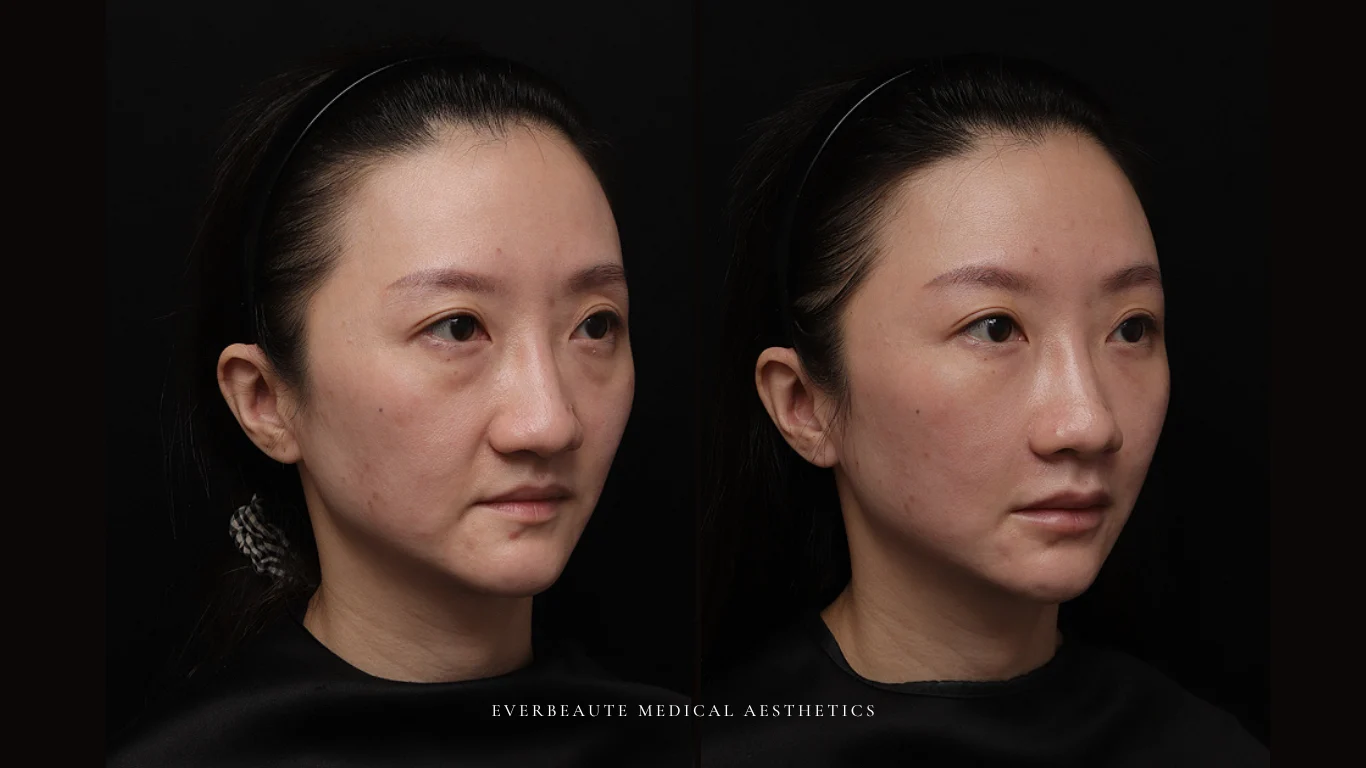 台北醫美推薦 大安區醫美 桃園微整 淚溝 眼袋 黑眼圈 豐唇 木偶紋 凝境美學診所 曾繁聞醫師 于曉恩醫師 皮膚科 專科 專業 效果自然 微整形 填補 填充 瑞士緹奧希 玻尿酸 喬雅登 水無痕 保柔緹 女神動態 熊貓針 淚溝針 童顏針 伊蓮絲 精靈針 喬雅露 逆時針 價格 副作用 後遺症 dcard ptt 成功案例 玻尿酸豐唇前後對比 豐唇、玻尿酸豐唇、自然豐唇、唇形改善、唇線重塑、唇峰設計、唇部微整形、豐唇注射推薦、自然飽滿唇、唇部玻尿酸 13