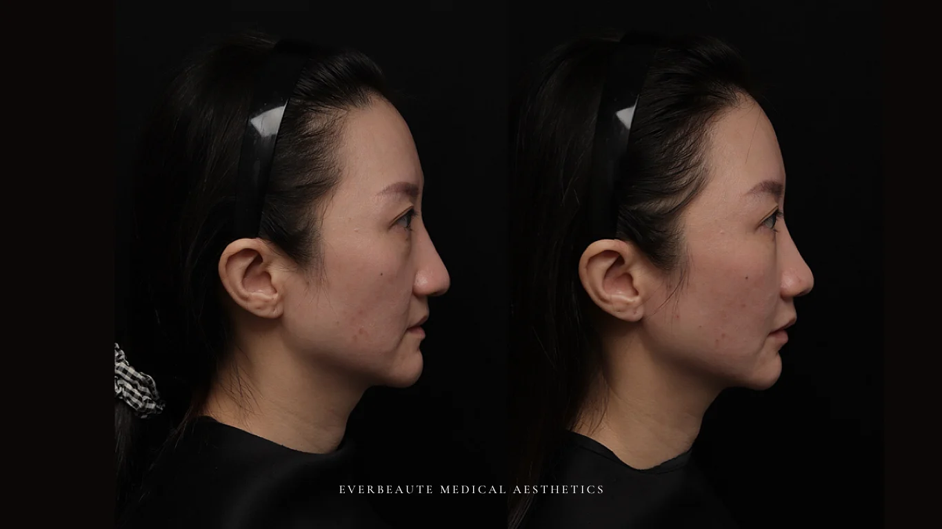 台北醫美推薦 大安區醫美 桃園微整 淚溝 眼袋 黑眼圈 豐唇 木偶紋 凝境美學診所 曾繁聞醫師 于曉恩醫師 皮膚科 專科 專業 效果自然 微整形 填補 填充 瑞士緹奧希 玻尿酸 喬雅登 水無痕 保柔緹 女神動態 熊貓針 淚溝針 童顏針 伊蓮絲 精靈針 喬雅露 逆時針 價格 副作用 後遺症 dcard ptt 成功案例 玻尿酸豐唇前後對比 豐唇、玻尿酸豐唇、自然豐唇、唇形改善、唇線重塑、唇峰設計、唇部微整形、豐唇注射推薦、自然飽滿唇、唇部玻尿酸 14