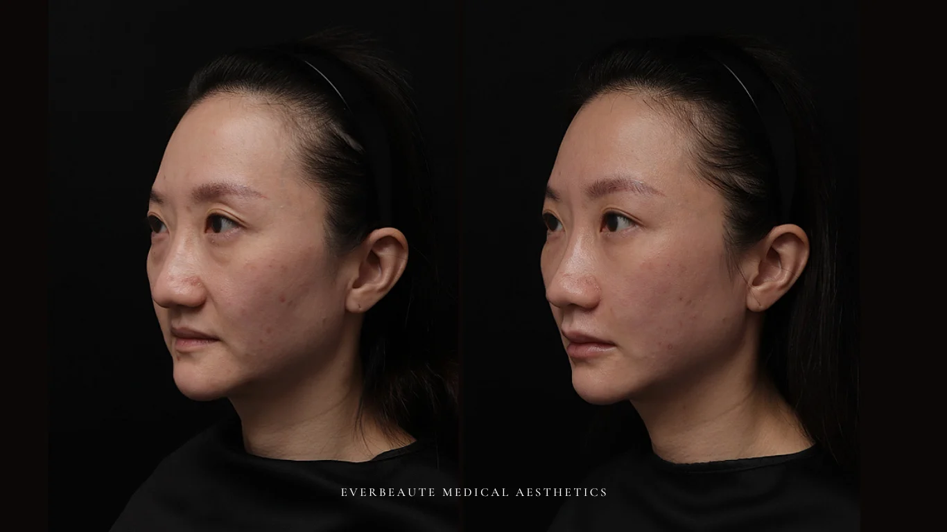 台北醫美推薦 大安區醫美 桃園微整 淚溝 眼袋 黑眼圈 豐唇 木偶紋 凝境美學診所 曾繁聞醫師 于曉恩醫師 皮膚科 專科 專業 效果自然 微整形 填補 填充 瑞士緹奧希 玻尿酸 喬雅登 水無痕 保柔緹 女神動態 熊貓針 淚溝針 童顏針 伊蓮絲 精靈針 喬雅露 逆時針 價格 副作用 後遺症 dcard ptt 成功案例 玻尿酸豐唇前後對比 豐唇、玻尿酸豐唇、自然豐唇、唇形改善、唇線重塑、唇峰設計、唇部微整形、豐唇注射推薦、自然飽滿唇、唇部玻尿酸 15